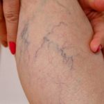 Как быстро вылечить воспаление вены на руке